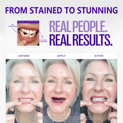 ❣️hismlle™ V36 Whitening Strips – Professional Teeth Whitening at Home(UPGRADED VERSION)（upsell ）