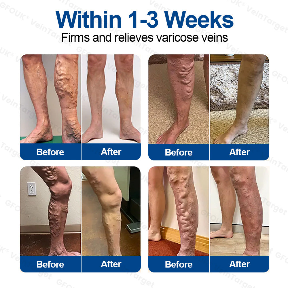 🇺🇸👨‍⚕️🦵✅GFOUK® VeinTarget Microneedle Patch⚡Instant Relief, Long-Term Results