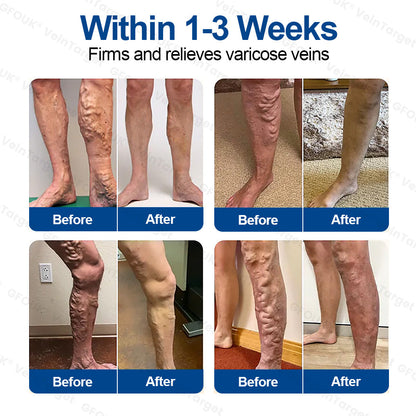 🇺🇸👨‍⚕️🦵✅GFOUK® VeinTarget Microneedle Patch⚡Instant Relief, Long-Term Results