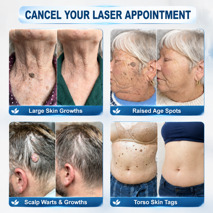 🏥👩‍⚕️Remifa®✨ 𝟕-𝐃𝒂𝘆 𝐒𝗸𝐢𝐧 𝐓𝒂𝗴 & 𝐒𝐩o𝐭 𝐄𝐫𝒂𝐬𝙚𝐫 𝐏𝐚𝐢𝐧𝐥𝐞𝐬𝐬 & 𝐒𝐜𝐚𝐫-𝐅𝐫𝐞𝐞 𝐀𝐝𝐯𝐚𝐧𝐜𝐞𝐝 𝐈𝐦𝐩𝐞𝐫𝐟𝐞𝐜𝐭𝐢𝐨𝐧 𝐑𝐞𝐦𝐨𝐯𝐚𝐥 𝐑𝐨𝐥𝐥𝐞𝐫𝐛𝐚𝐥𝐥 𝐏𝐞𝐧