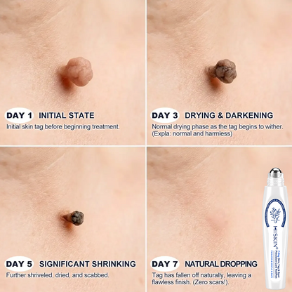 🏥👩‍⚕️Remifa®✨ 𝟕-𝐃𝒂𝘆 𝐒𝗸𝐢𝐧 𝐓𝒂𝗴 & 𝐒𝐩o𝐭 𝐄𝐫𝒂𝐬𝙚𝐫 𝐏𝐚𝐢𝐧𝐥𝐞𝐬𝐬 & 𝐒𝐜𝐚𝐫-𝐅𝐫𝐞𝐞 𝐀𝐝𝐯𝐚𝐧𝐜𝐞𝐝 𝐈𝐦𝐩𝐞𝐫𝐟𝐞𝐜𝐭𝐢𝐨𝐧 𝐑𝐞𝐦𝐨𝐯𝐚𝐥 𝐑𝐨𝐥𝐥𝐞𝐫𝐛𝐚𝐥𝐥 𝐏𝐞𝐧