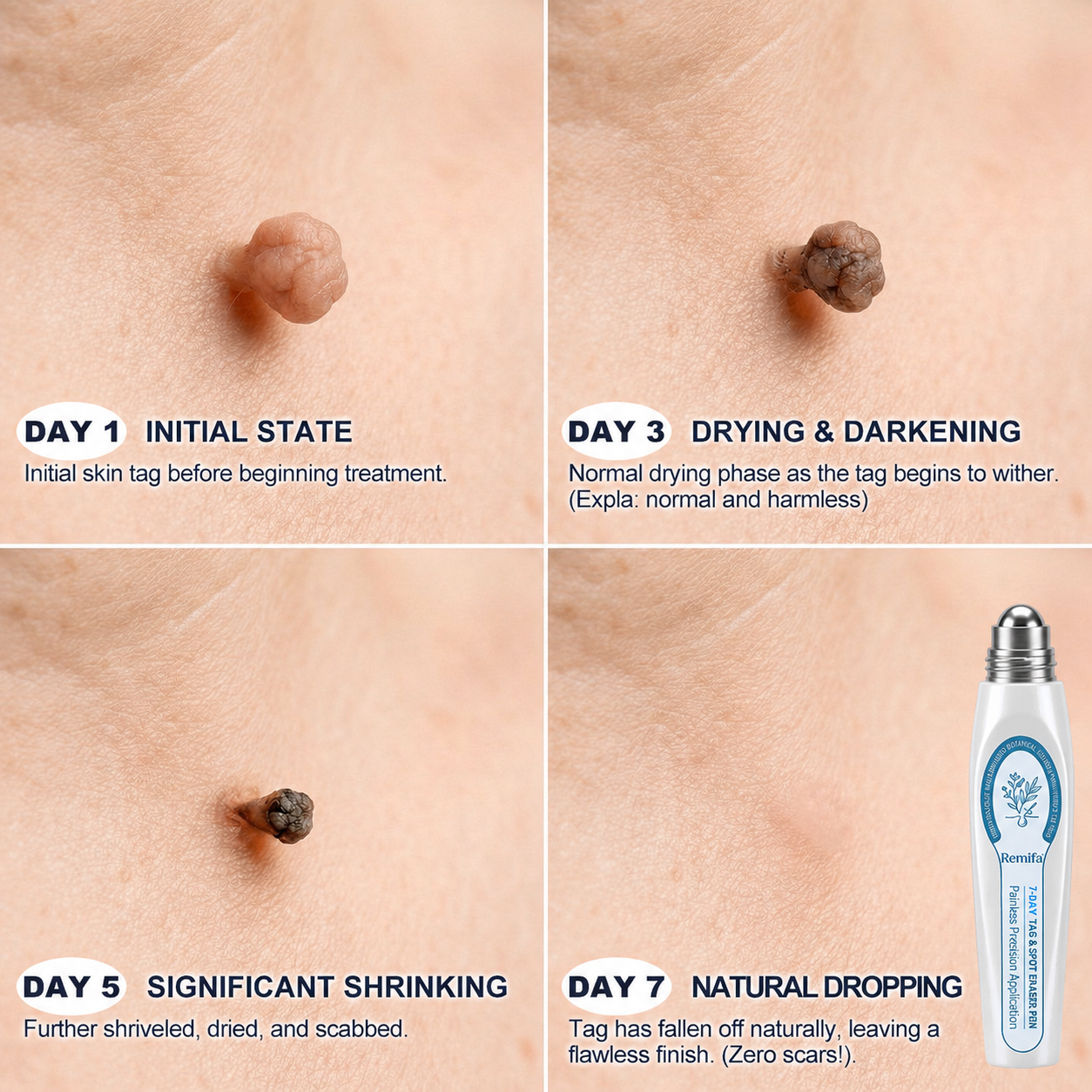 Remifa®𝟕-𝐃𝒂𝘆 𝐒𝗸𝐢𝐧 𝐓𝒂𝗴 & 𝐒𝐩o𝐭 𝐄𝐫𝒂𝐬𝙚𝐫 𝐏𝐚𝐢𝐧𝐥𝐞𝐬𝐬 & 𝐒𝐜𝐚𝐫-𝐅𝐫𝐞𝐞 𝐀𝐝𝐯𝐚𝐧𝐜𝐞𝐝 𝐈𝐦𝐩𝐞𝐫𝐟𝐞𝐜𝐭𝐢𝐨𝐧 𝐑𝐞𝐦𝐨𝐯𝐚𝐥 𝐑𝐨𝐥𝐥𝐞𝐫𝐛𝐚𝐥𝐥 𝐏𝐞𝐧（syzusqzbupsell）