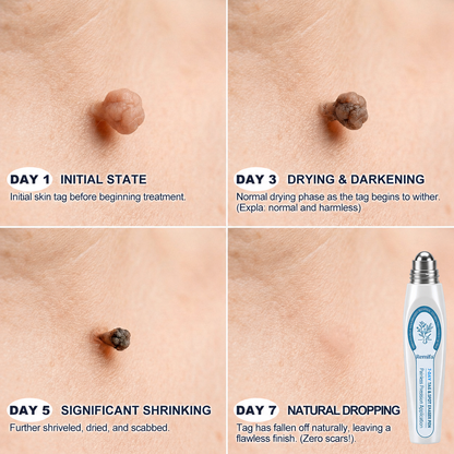 Remifa®𝟕-𝐃𝒂𝘆 𝐒𝗸𝐢𝐧 𝐓𝒂𝗴 & 𝐒𝐩o𝐭 𝐄𝐫𝒂𝐬𝙚𝐫 𝐏𝐚𝐢𝐧𝐥𝐞𝐬𝐬 & 𝐒𝐜𝐚𝐫-𝐅𝐫𝐞𝐞 𝐀𝐝𝐯𝐚𝐧𝐜𝐞𝐝 𝐈𝐦𝐩𝐞𝐫𝐟𝐞𝐜𝐭𝐢𝐨𝐧 𝐑𝐞𝐦𝐨𝐯𝐚𝐥 𝐑𝐨𝐥𝐥𝐞𝐫𝐛𝐚𝐥𝐥 𝐏𝐞𝐧（syzusqzbupsell）